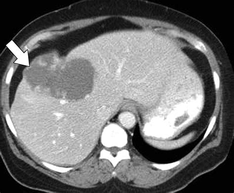 Ct And Mri Of Hepatic Contour Abnormalities Ajr