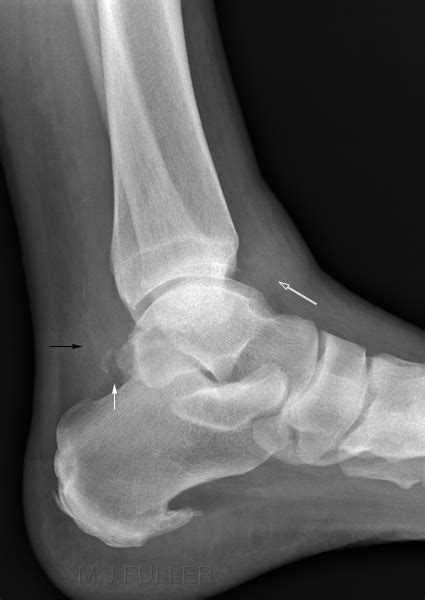 Imaging Talar Fractures Wikiradiography