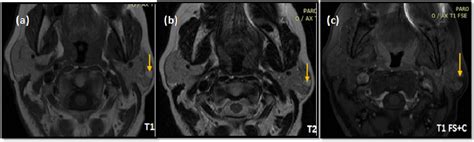 Anatomy And Common Pathology Of The Parotid Space The Imaging