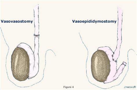 vasectomy reversal northern california fertility medical center