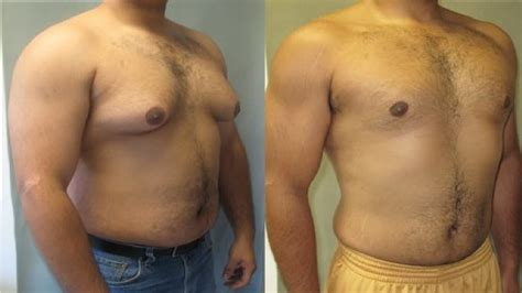 how to get rid of gynecomastia in teenagers now youtube