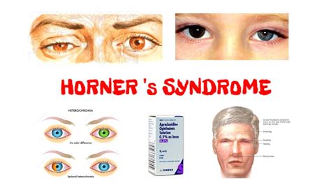 Horner S Syndrome Horner S Syndrome Anatomy Horner S Syndrome