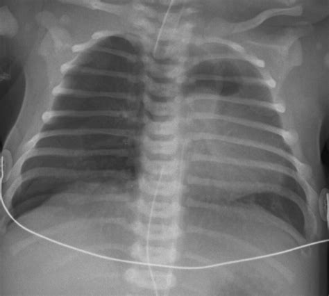 Infantile respiratory distress syndrome (irds), also called respiratory distress syndrome of newborn, or increasingly surfactant deficiency disorder (sdd), and previously called hyaline membrane disease (hmd), is a syndrome in premature infants caused by developmental insufficiency of pulmonary surfactant production and structural immaturity in the lungs. Health Care: Child Health Problems