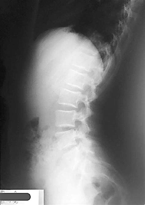 X Rays Of Patient 2 Enhanced Lumbar Lordosis Download Scientific
