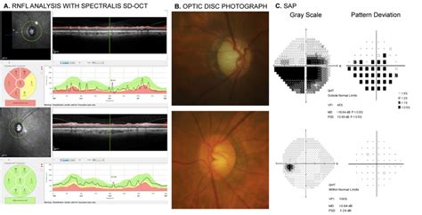 Printout Of Retinal Nerve Fiber Layer RNFL Analysis Obtained With The