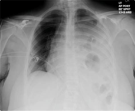 Portable Chest Radiograph Obtained After Needle Thoracostomy