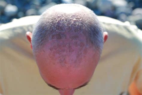 Dry Flaky Skin On Your Bald Head Prevention And Treatment Shaving Advisor