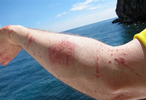 How To Treat A Jellyfish Sting First Aid Training Cooperative