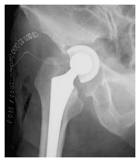 Anteroposterior Radiograph Showing Severe Acetabular Bone Loss