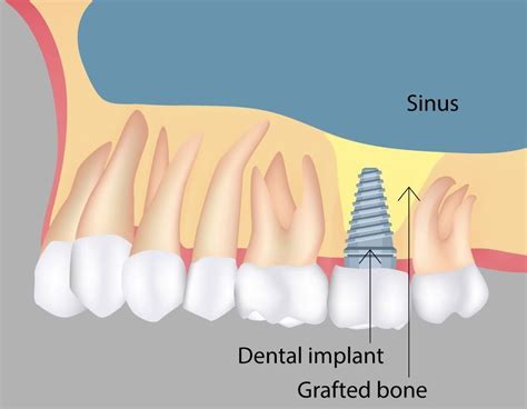 Sinus Lift Richmond Va Davey Crockett Dentistry Dental Implants