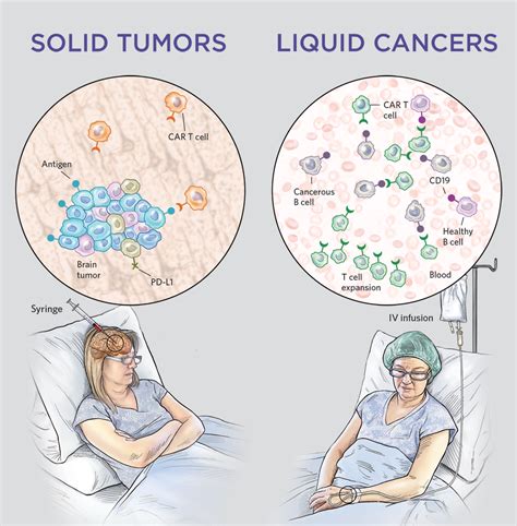 The Next Frontier Of Car T Cell Therapy Solid Tumors The Scientist