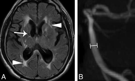 Brain Mr Imaging Findings Of Cardiac Type Fabry Disease With An Ivs4