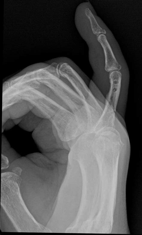 Middle And Distal Phalanx Avulsion Fracture Image