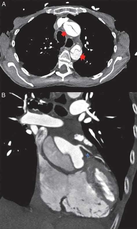 Ascending Aortic Dissection Presented As Inferior Myocardial Infarction