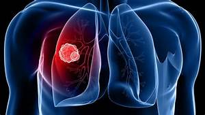 Can Machine Learning Really Detect Lung Cancer? - Tahsin Hassan Rahit Lung Cancer  