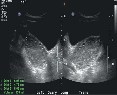 Ovarian Torsion Radiology Key