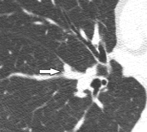 Perifissural Nodules Seen At Ct Screening For Lung Cancer Radiology