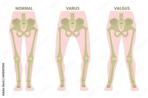 Vetor Do Stock Valgus And Varus Leg Deformities Diagram Showing The Deformed Bones Of The