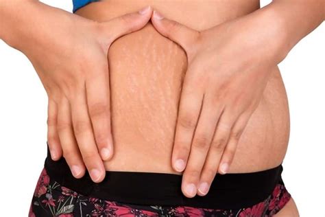 If john doesn't hurry c. Will Stretch Marks Go Away If I Lose Weight? The Answers ...