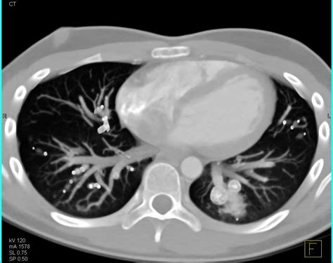 Multiple Pulmonary Arteriovenous Malformations Avm Chest Case