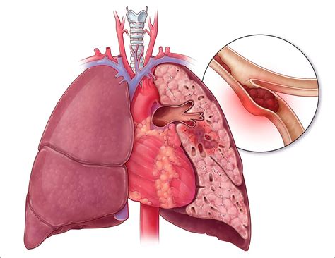 When a dvt forms, it can partially or completely block the flow of blood through the vein. Pin on Health - Pulmonary Embolism