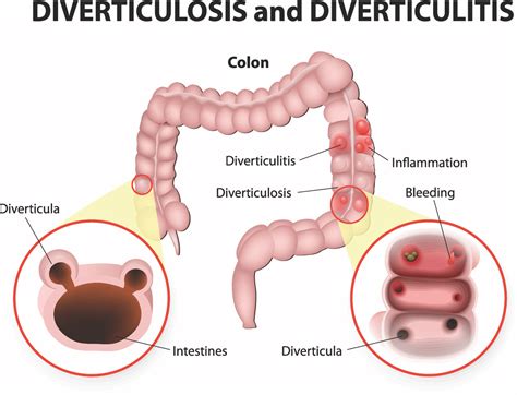 Rectal Bleeding PRIVATE GASTRO LONDON