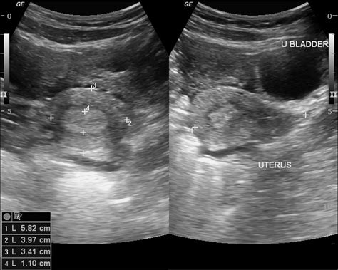 Ruptured Hemorrhagic Corpus Luteal Cyst Image