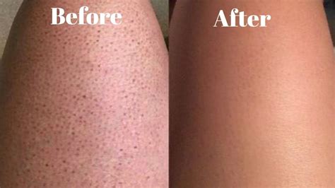 Ingrown Hair Scars On Thighs See Clearly Blogger Lightbox