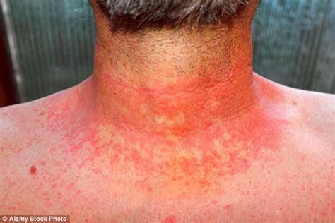 Scarlet Fever Returns As Doctors Are Warned About Possible Outbreak