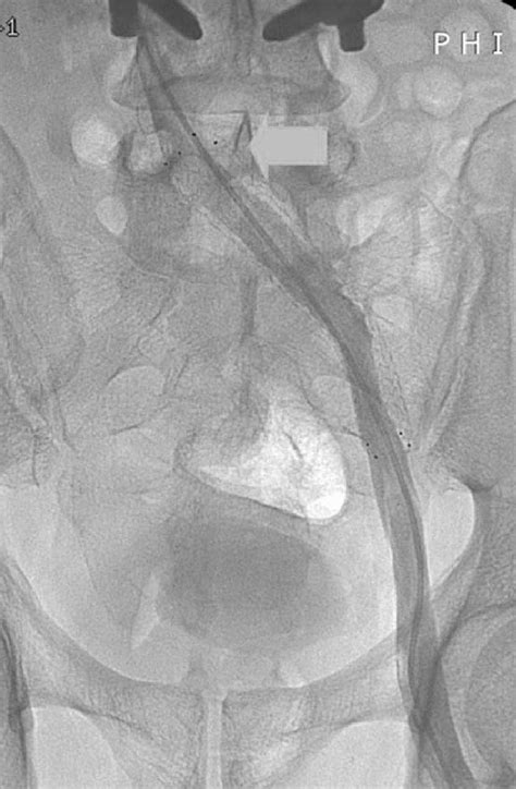 Stent Is Inserted To The Compressed Site Of Left Common Iliac Vein