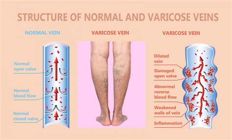 What Causes Vein Disorders Vein Specialists Of The Carolinas