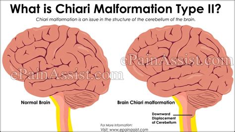 What Is Chiari Malformation Type Ii How Does It Affect My Xxx Hot Girl