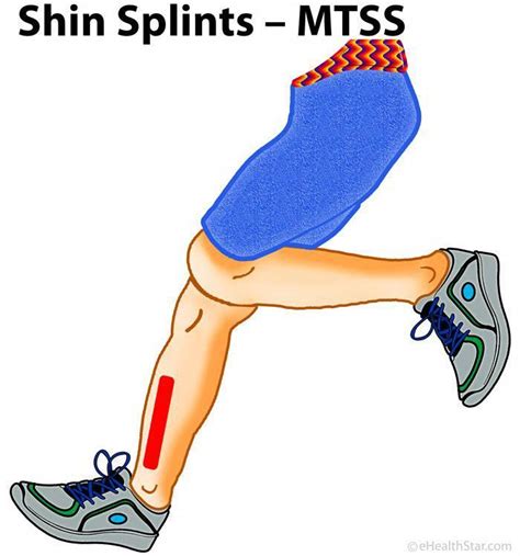 Pin On Stop Shin Splints