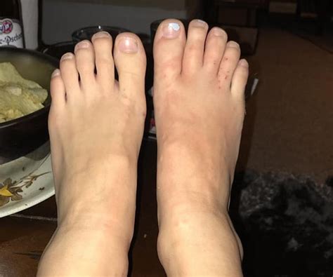 Couple Get Hookworms In Feet After Walking Barefoot In Sand
