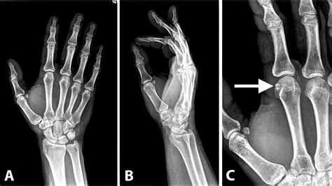 Sesamoid Bone