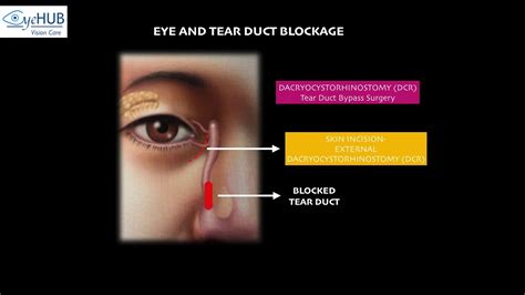 Block Tear Duct Part 1 Watering In Eyes Endoscopic