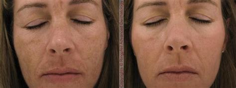 Creams for melasma work by protecting your face from the sun rays that darken your melasma patches and make them worse. Melasma how to cure