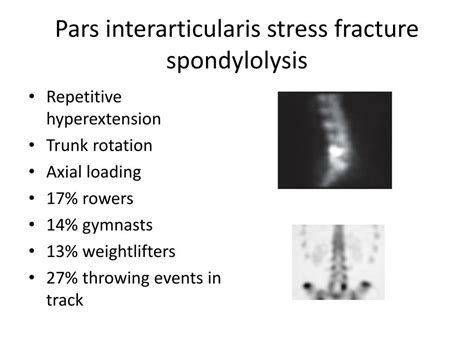 Ppt Stress Fractures Powerpoint Presentation Free Download Id2029931