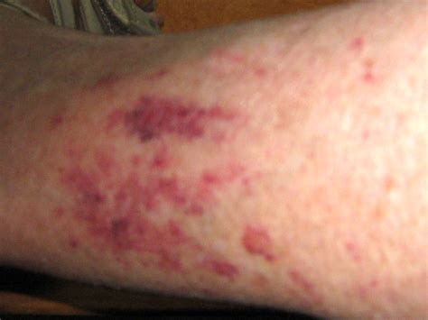 Red Blotches On Lower Legs Pictures Photos
