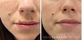 Images of Beauty Spot Removal Nhs