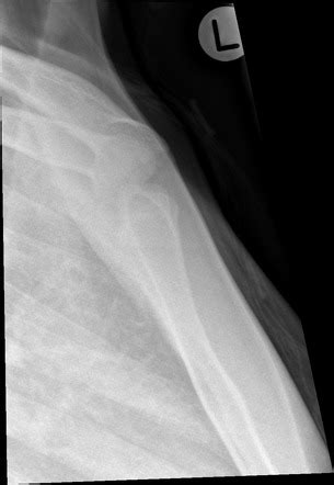 Sternoclavicular Joint Series Radiology Reference Article