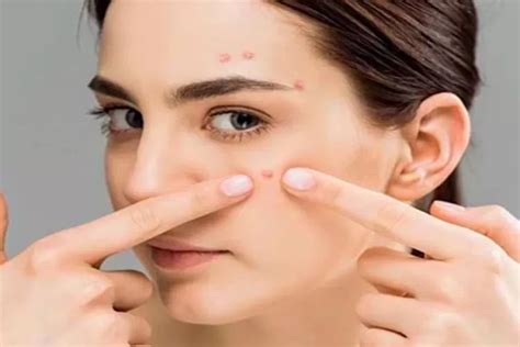 Perbedaan Blackhead Dan Whitehead Yang Perlu Anda Ketahui Suara Merdeka