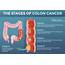 Signs Of Early Stage Colon Cancer  Risks And Colorectal