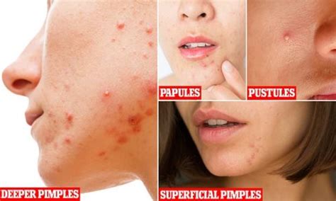 What Type Of Spots Do You Have Expert Reveals The Six Different Kinds