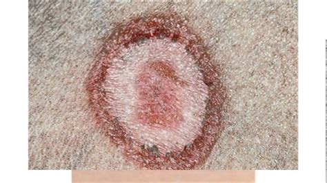 Images Of Ringworm In Humans Youtube