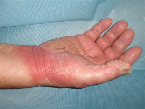 Contact Dermatitis Stock Image C0384456 Science Photo Library