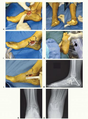 Medial Ankledeltoid Ligament Reconstruction Musculoskeletal Key