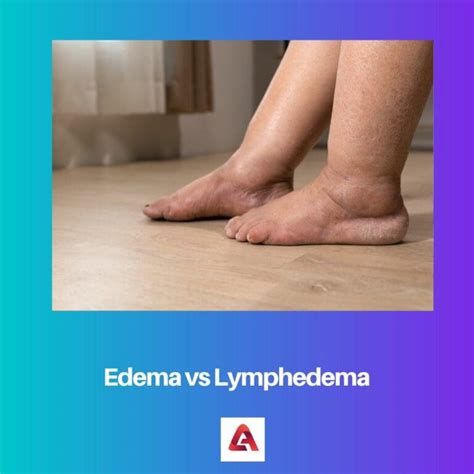 Edema Vs Lymphedema Difference And Comparison