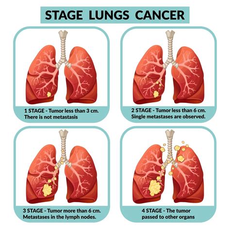Stage Lung Cancer Treatments Cancerprotalk Com