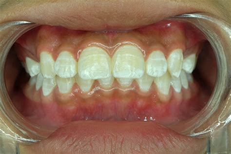 A Drill Free Approach To Removing White Spots On Your Teeth New York